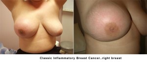 classic-inflammatory-breast-cancer