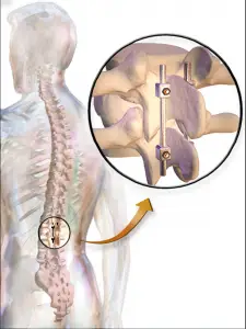 Nerve Pain